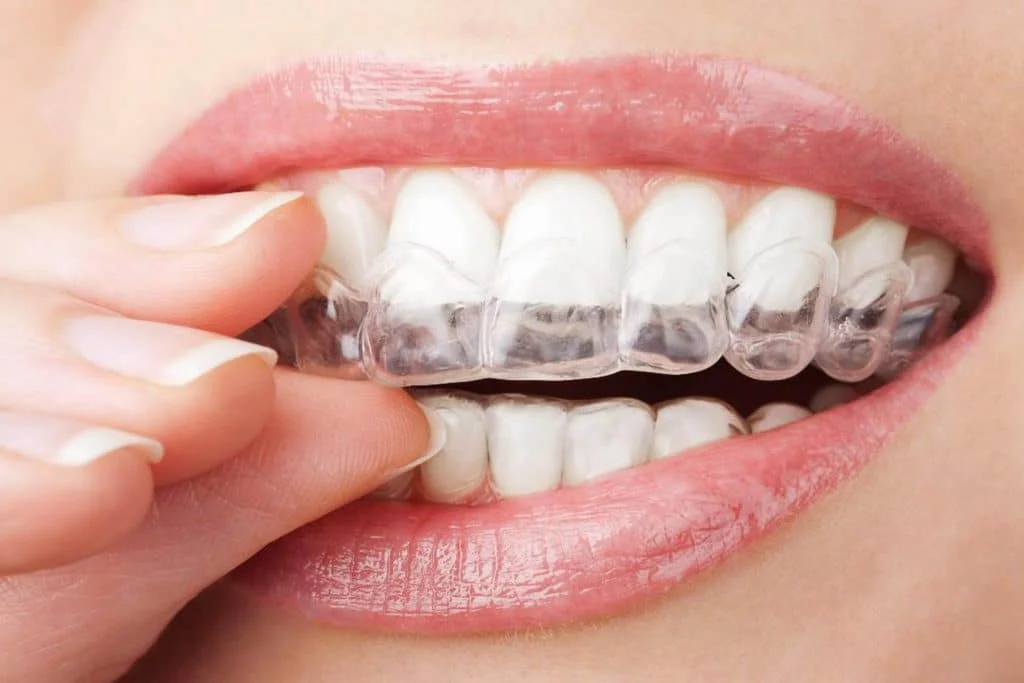 Orthodontic Services (Clear Braces, NHS Costs & Invisalign) 27 7 Things You Must Know Before Trying Invisible Braces 1 1024x683 1 Orthodontic Services (Clear Braces, NHS Costs & Invisalign)