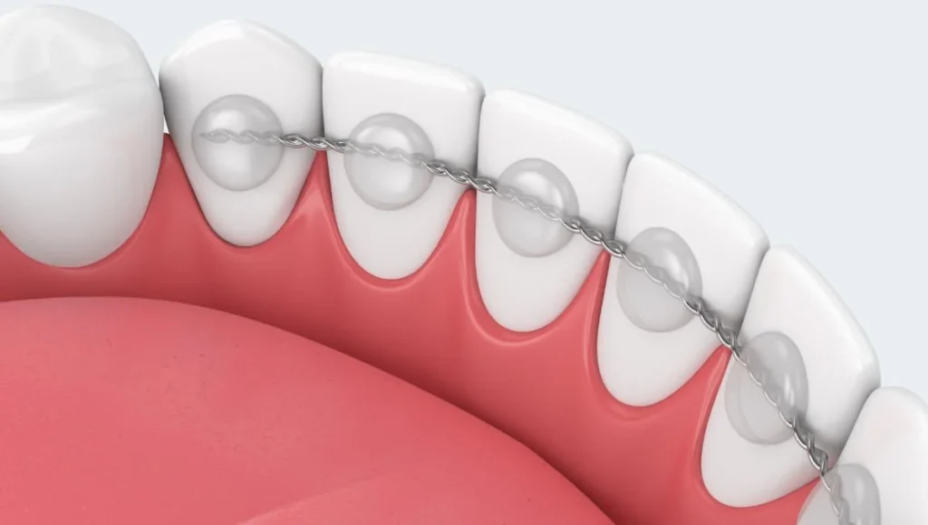 Orthodontic Services (Clear Braces, NHS Costs & Invisalign) 29 Fixed Retainers Orthodontic Services (Clear Braces, NHS Costs & Invisalign)