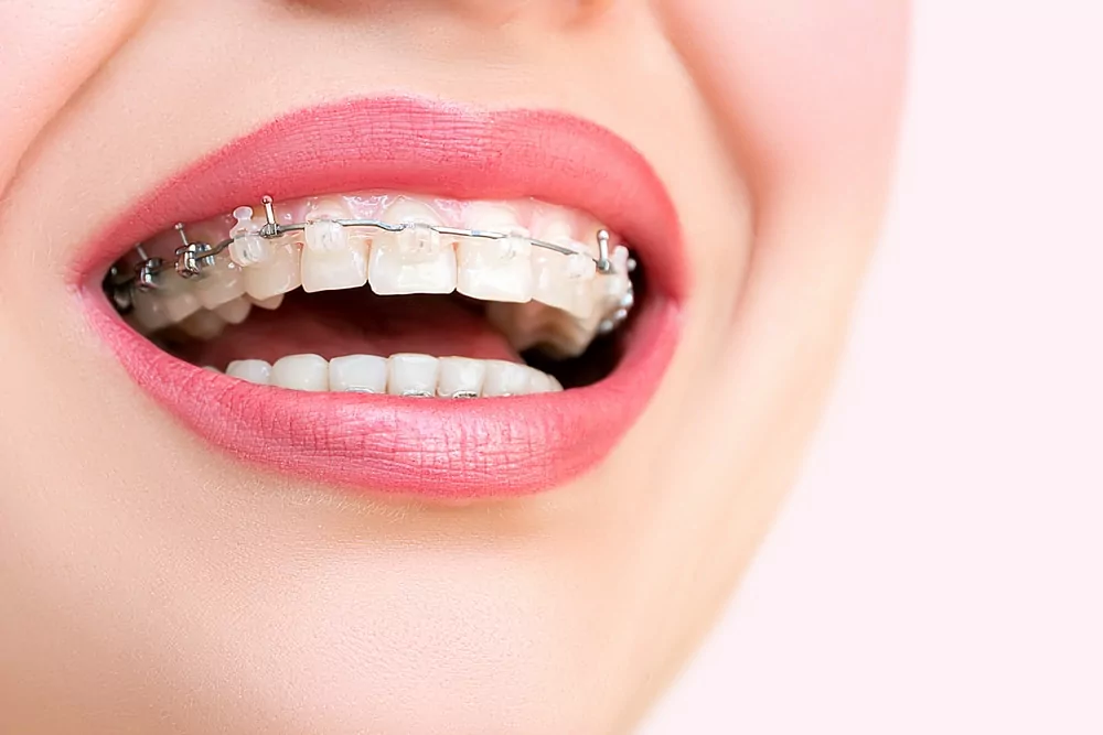 Orthodontic Services (Clear Braces, NHS Costs & Invisalign) 28 shutterstock 352848512 Orthodontic Services (Clear Braces, NHS Costs & Invisalign)