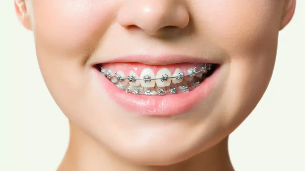 Orthodontic Services (Clear Braces, NHS Costs & Invisalign) 30 the importance of early orthodontic assessment for children v2.jpg Orthodontic Services (Clear Braces, NHS Costs & Invisalign)