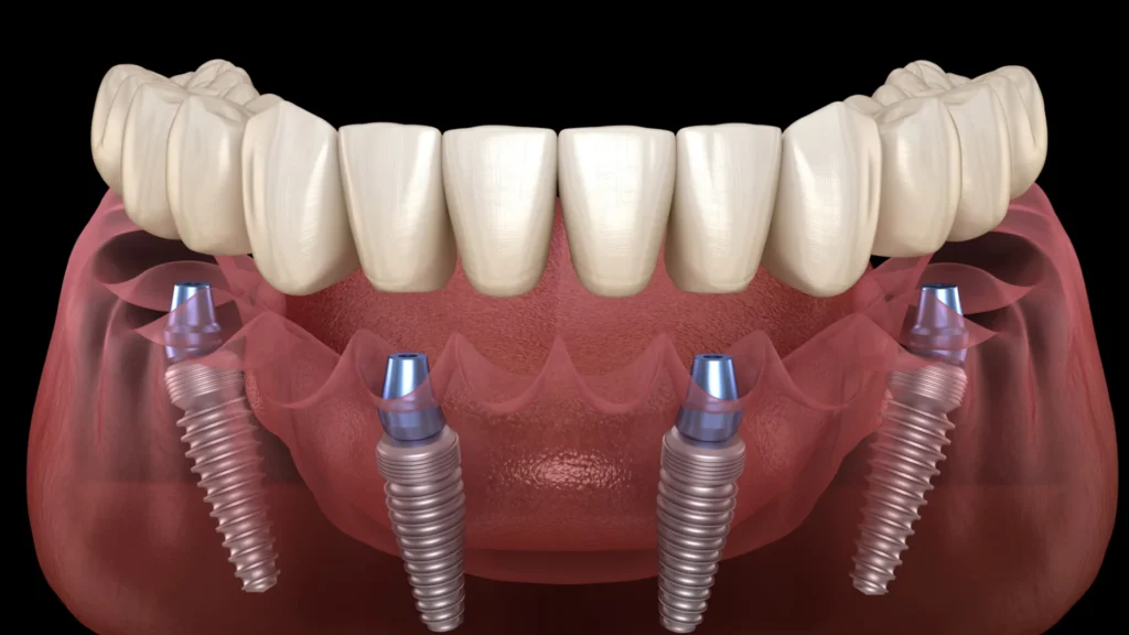 All on 4 dental implants