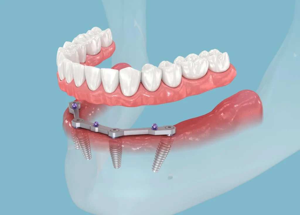 All on 4 Dental Implants: Cost, Benefits & Long-Term Success 26 Four titanium implants
