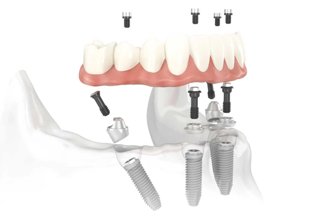 All on 4 Dental Implants: Cost, Benefits & Long-Term Success 27 All on 4 dental implants2 All on 4 Dental Implants: Cost, Benefits & Long-Term Success