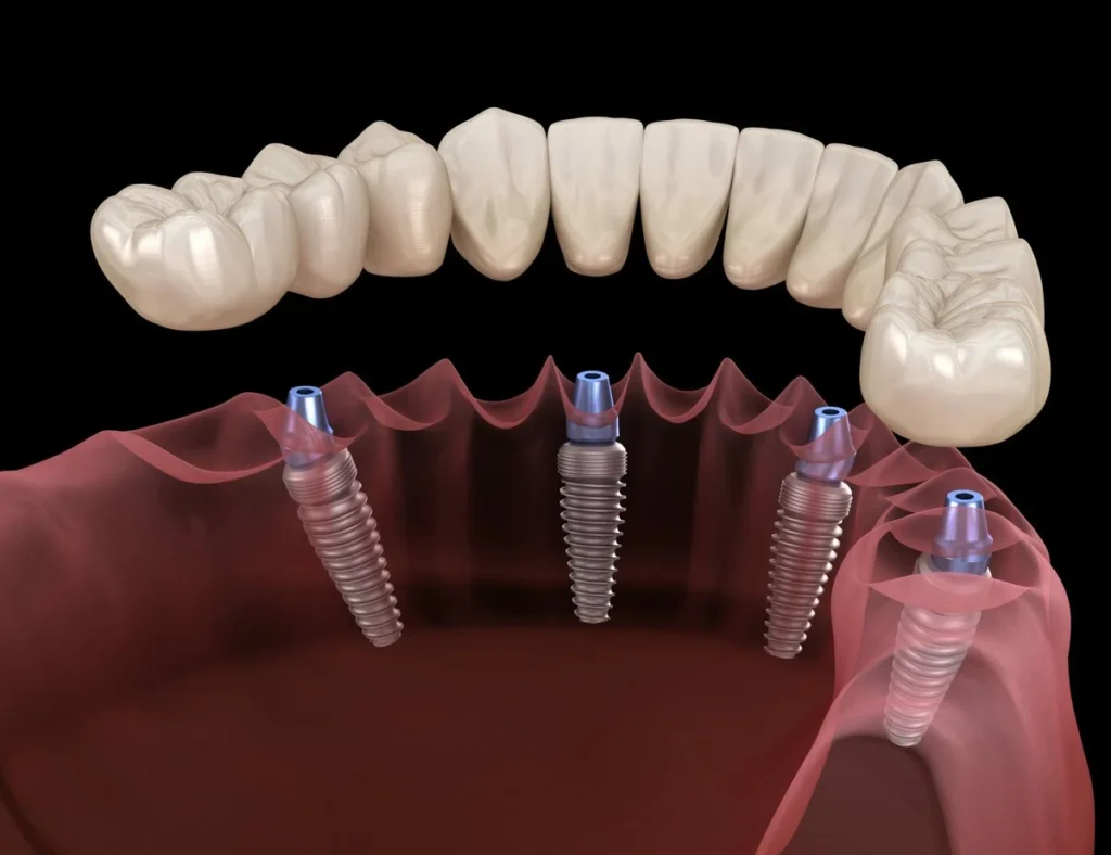 All on 4 Dental Implants: Cost, Benefits & Long-Term Success 28 All on 4 dental implants3 All on 4 Dental Implants: Cost, Benefits & Long-Term Success
