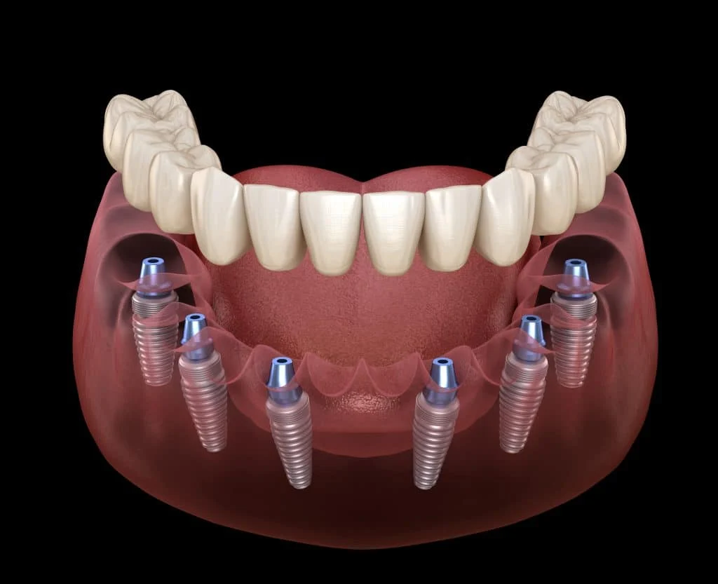All on 4 Dental Implants: Cost, Benefits & Long-Term Success 30 All on 6 1 All on 4 Dental Implants: Cost, Benefits & Long-Term Success