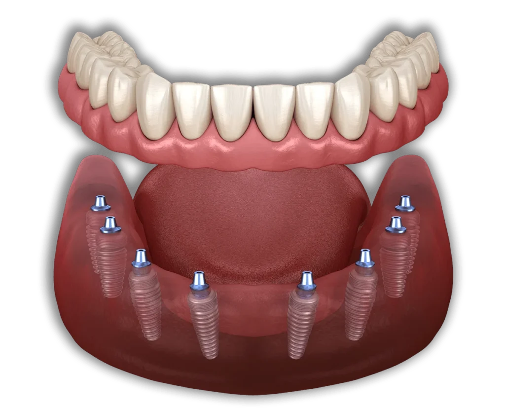 All on 8 dental implants​1 All-On-8 Dental Implants (Cost, Benefits & Packages)
