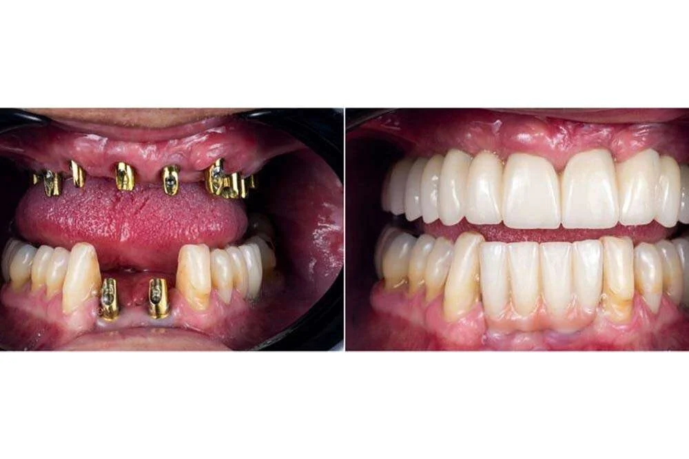 All on 8 dental implants​2 All-On-8 Dental Implants (Cost, Benefits & Packages)