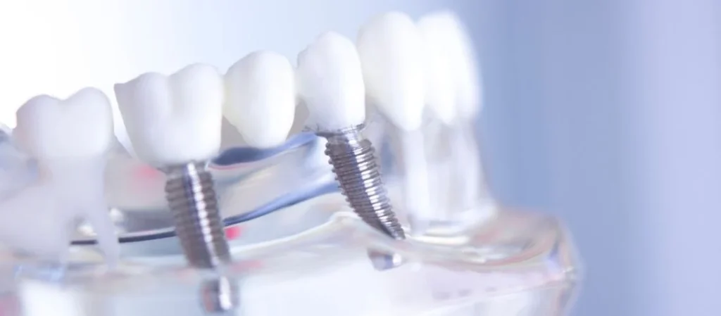 All on 8 dental implants​3 All-On-8 Dental Implants (Cost, Benefits & Packages)