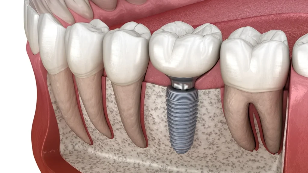 All on 8 dental implants​4 All-On-8 Dental Implants (Cost, Benefits & Packages)