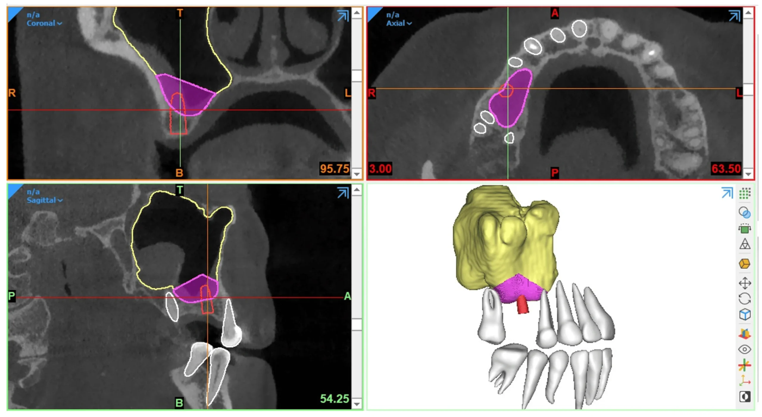 CBCT diagnoze planning2 scaled Diagnoza CBCT dhe Planifikimi