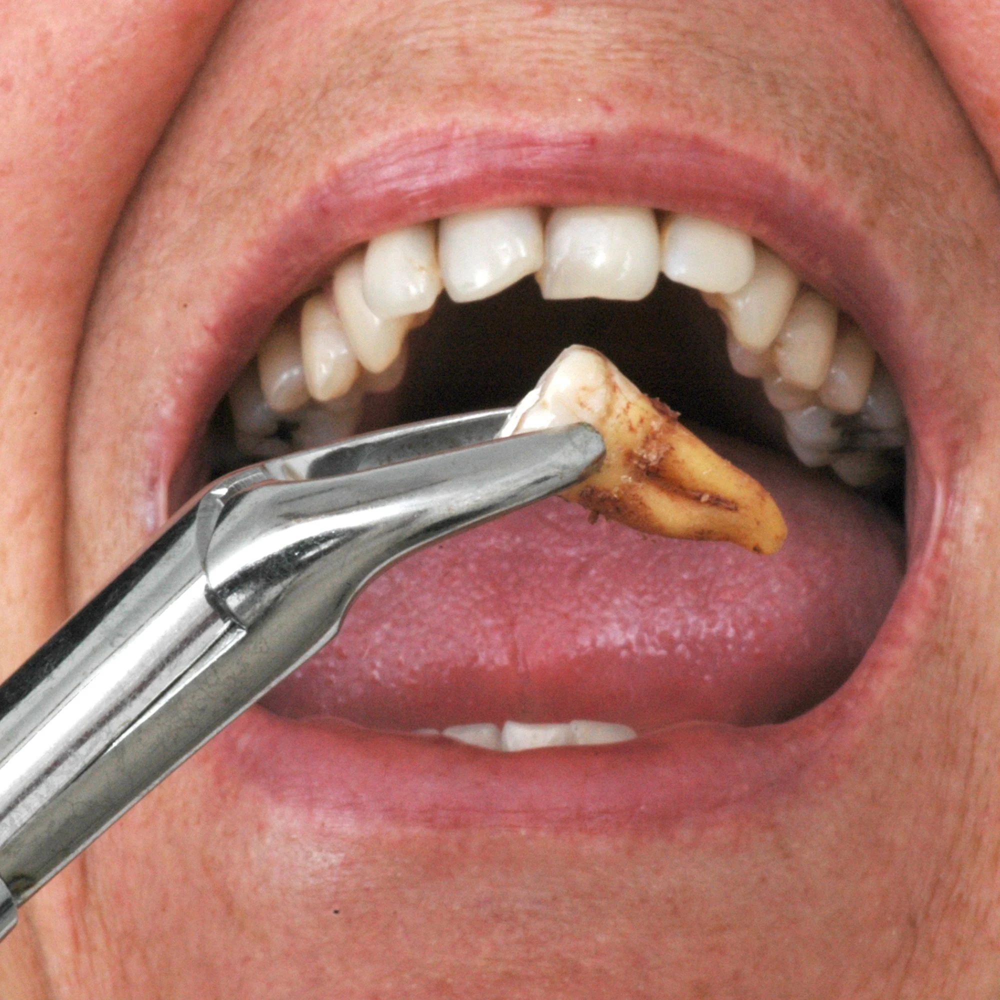 Heqja e dhembit 12 Heqje2 Heqja e dhembit