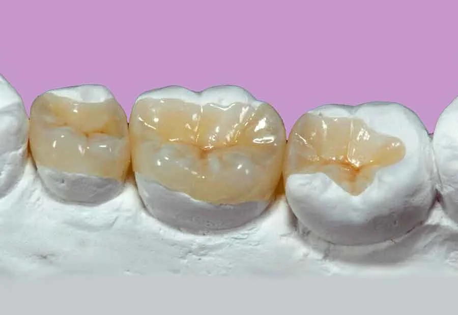 INLAYS AND ONLAYS1 INLAYS DHE ONLAYS