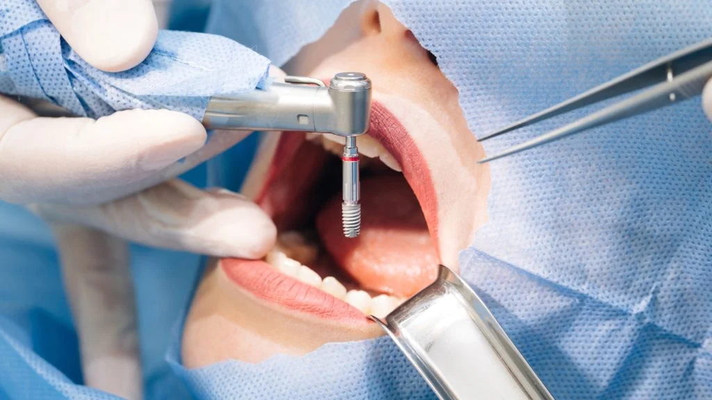 Immediate Load Dental Implants (Benefits, Risks & Full Process) 22 Immediate load dental implants2 Immediate Load Dental Implants (Benefits, Risks & Full Process)