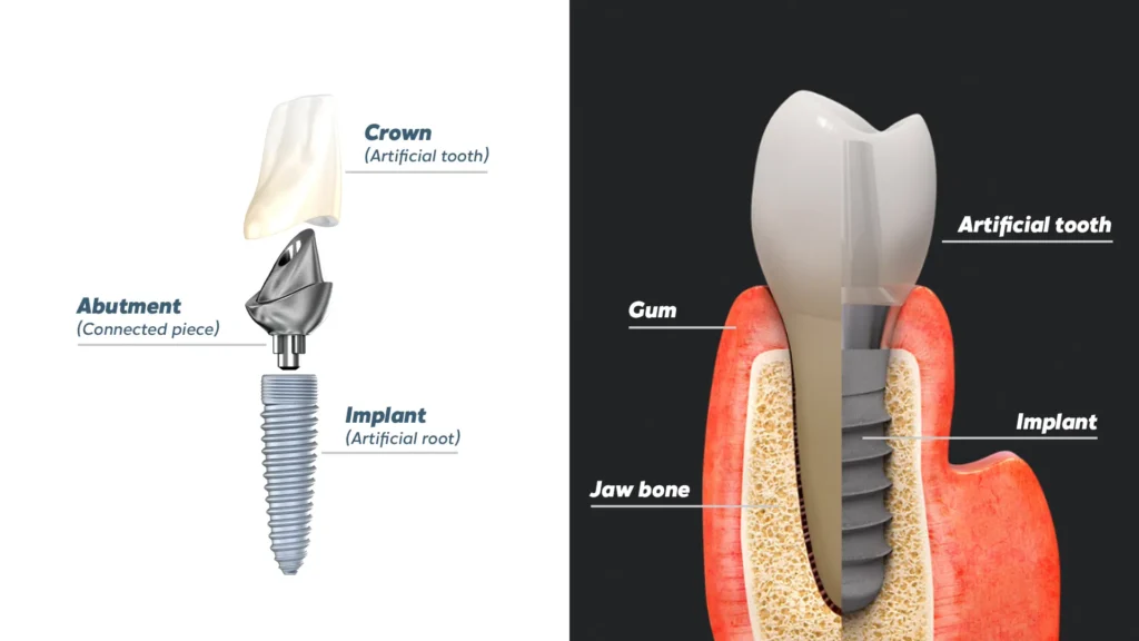 Immediate Load Dental Implants (Benefits, Risks & Full Process) 23 Immediate load dental implants3 Immediate Load Dental Implants (Benefits, Risks & Full Process)