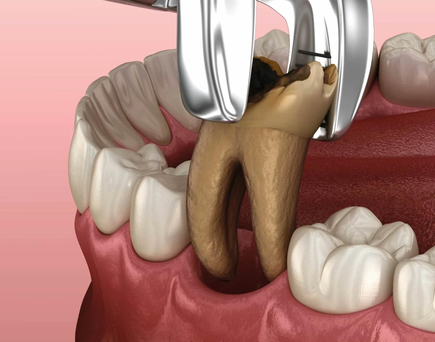 Tooth Extraction
