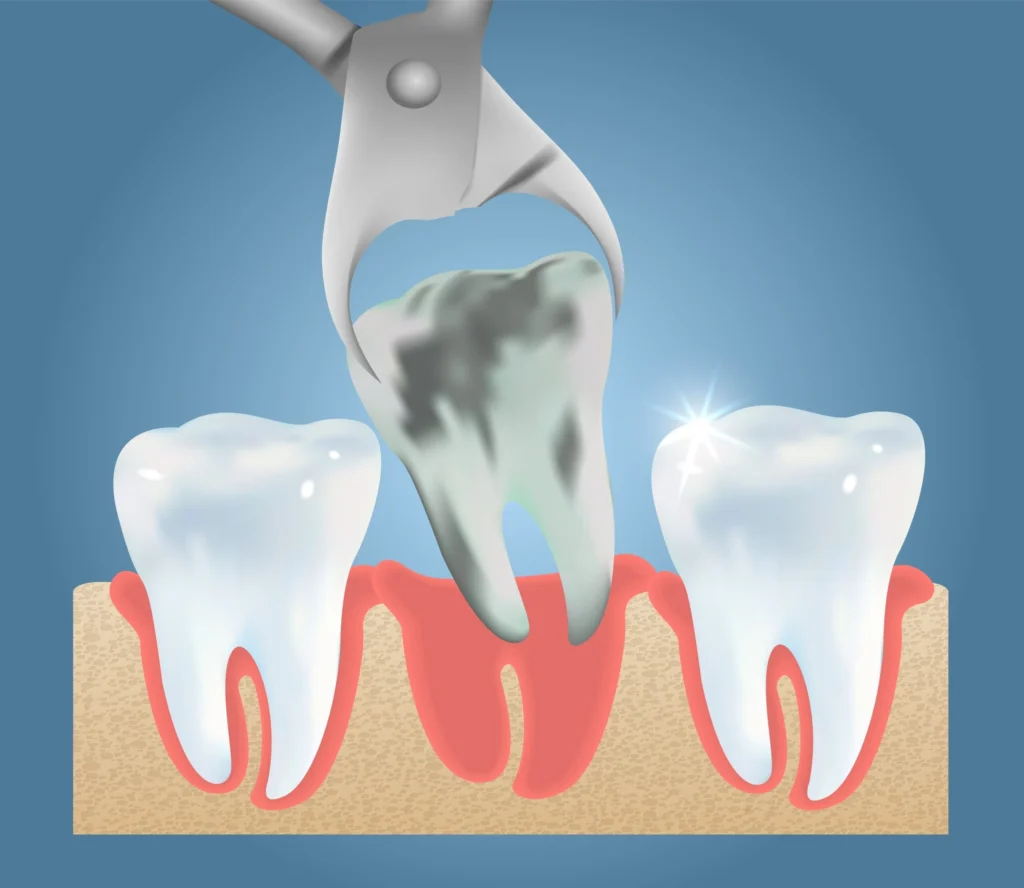 Tooth Extraction (Pain, Recovery & Aftercare Tips) 18 Tooth Extraction