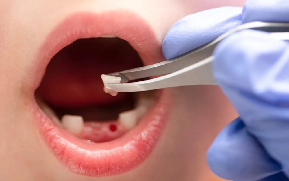 Tooth Tooth Extraction: Procedure, Pain, And Fast Recovery