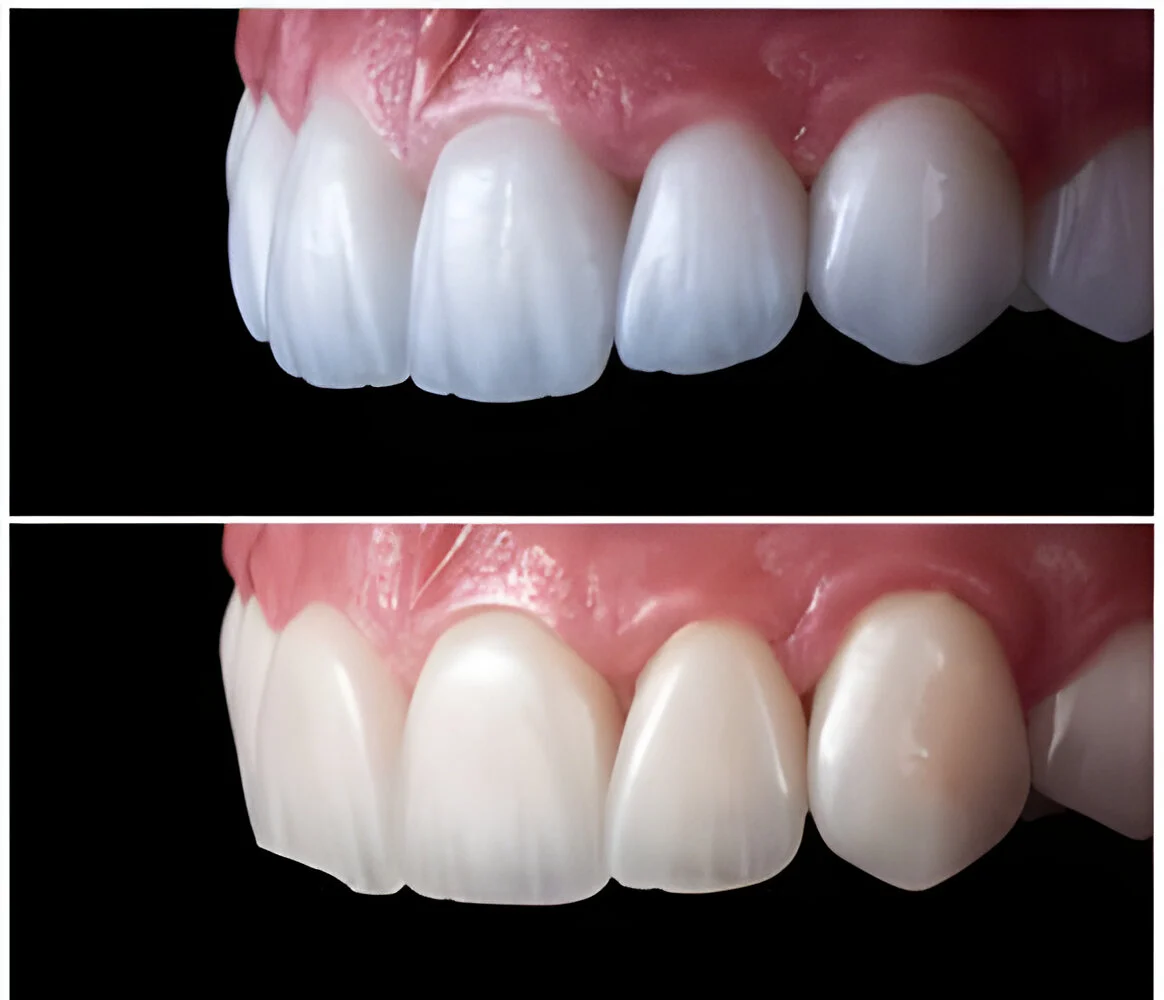 Veneers E MAX Faseta E-MAX