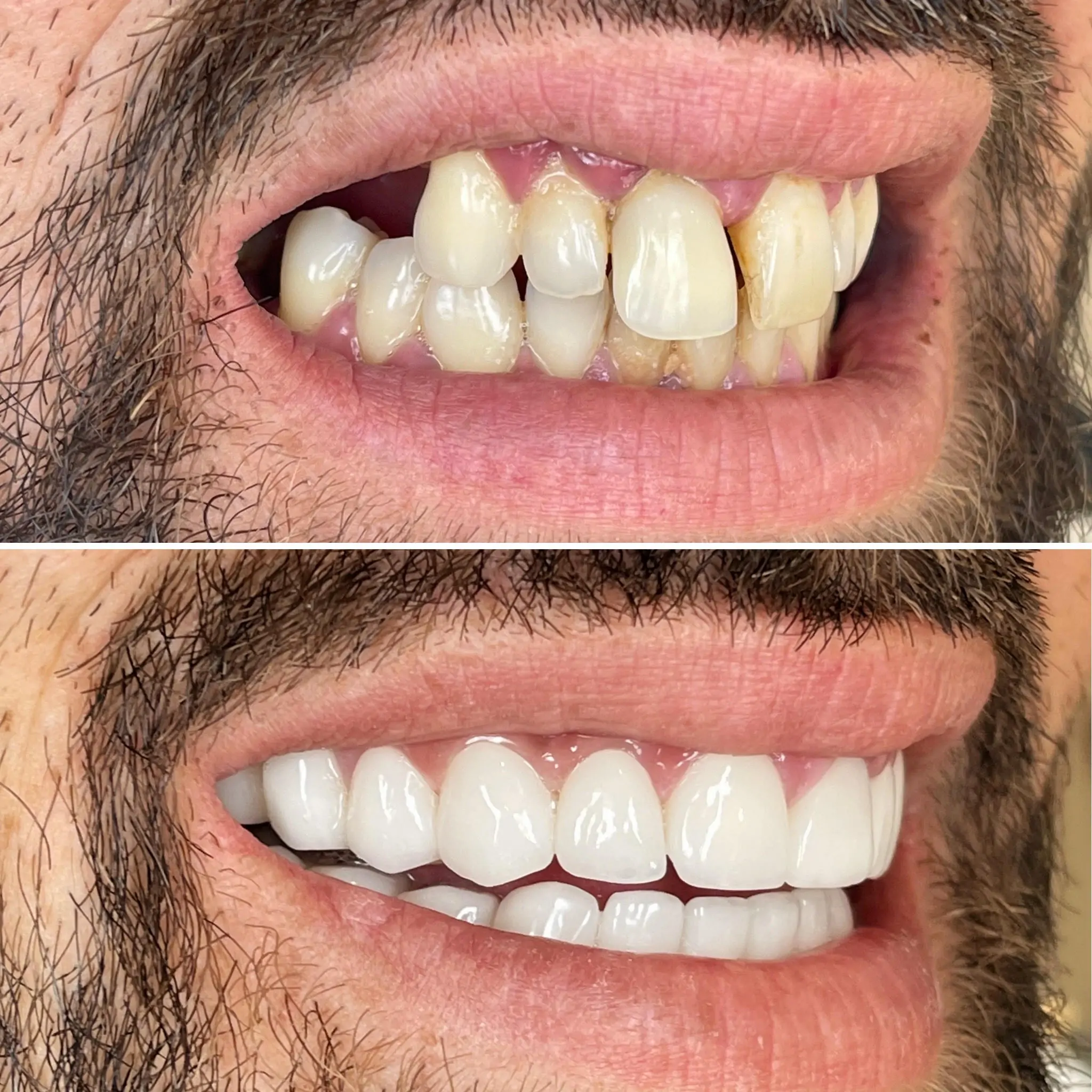 Veneers E MAX1 Faseta E-MAX