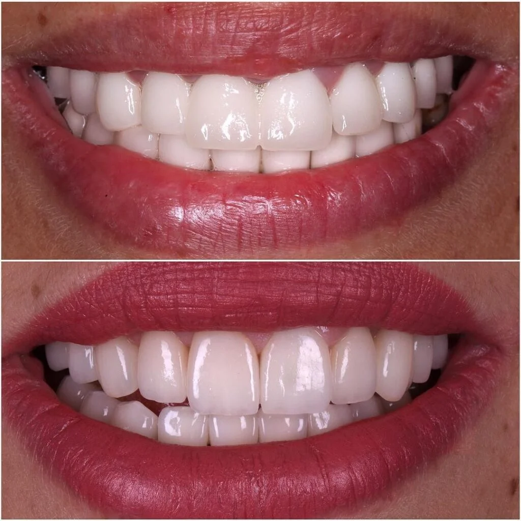 Veneers E MAX2 Faseta E-MAX