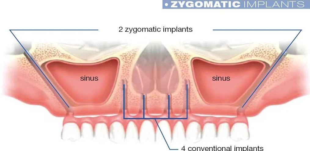 Zygomatic Implants (Cost, Sinus Surgery Alternative & Success Rates) 23 Zygomatic Implants3 Zygomatic Implants (Cost, Sinus Surgery Alternative & Success Rates)