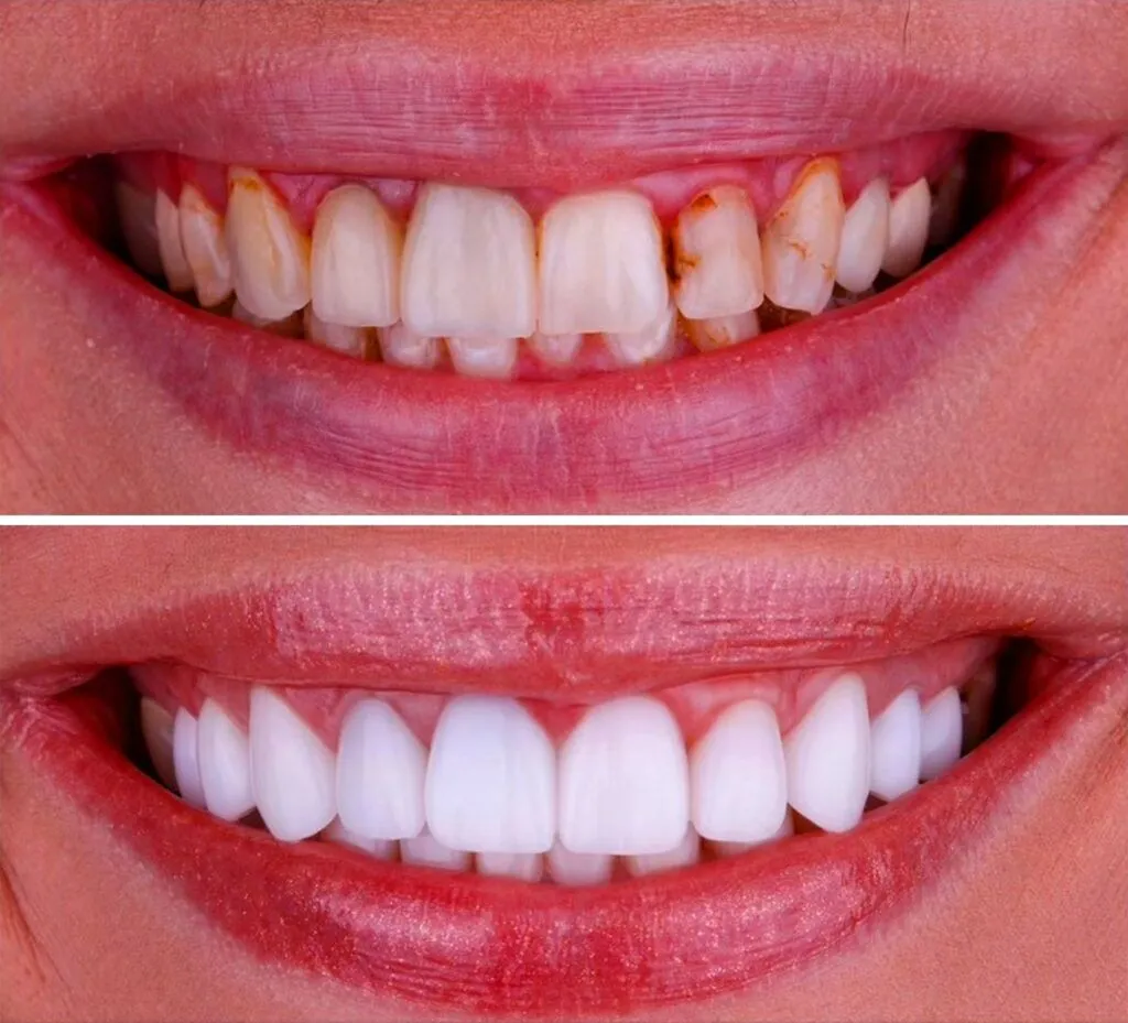 bonding BONDING DENTAR