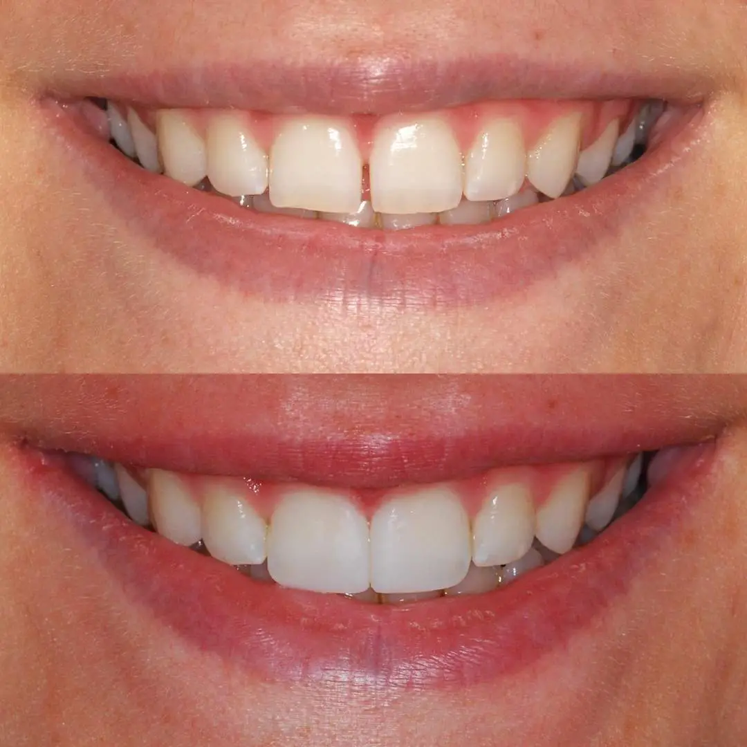 bonding1 BONDING DENTAR