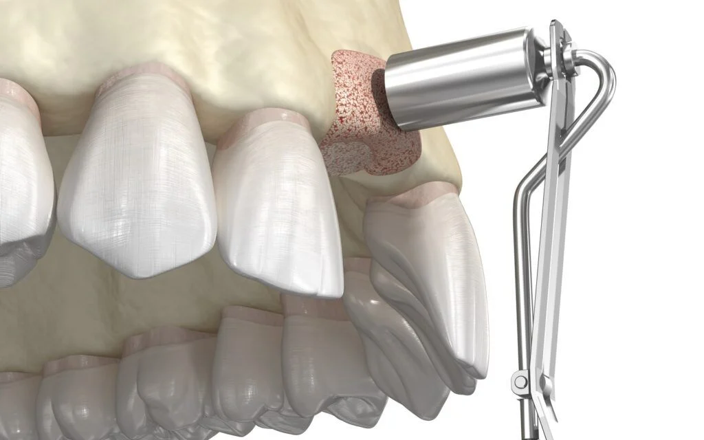 Bone grafting for dental implants (Costs, Pain & Healing Time) 24 bone grafting for dental implants4 Bone grafting for dental implants (Costs, Pain & Healing Time)