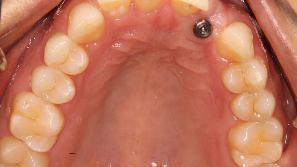 Immediate loading vs delayed loading implants 21 immediate loading vs delayed loading implants1 Immediate loading vs delayed loading implants