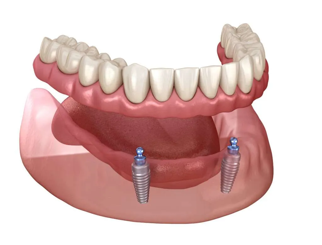 Implant supported dentures (Benefits, Costs & Procedure Explained) 21 implant supported dentures1 Implant supported dentures (Benefits, Costs & Procedure Explained)