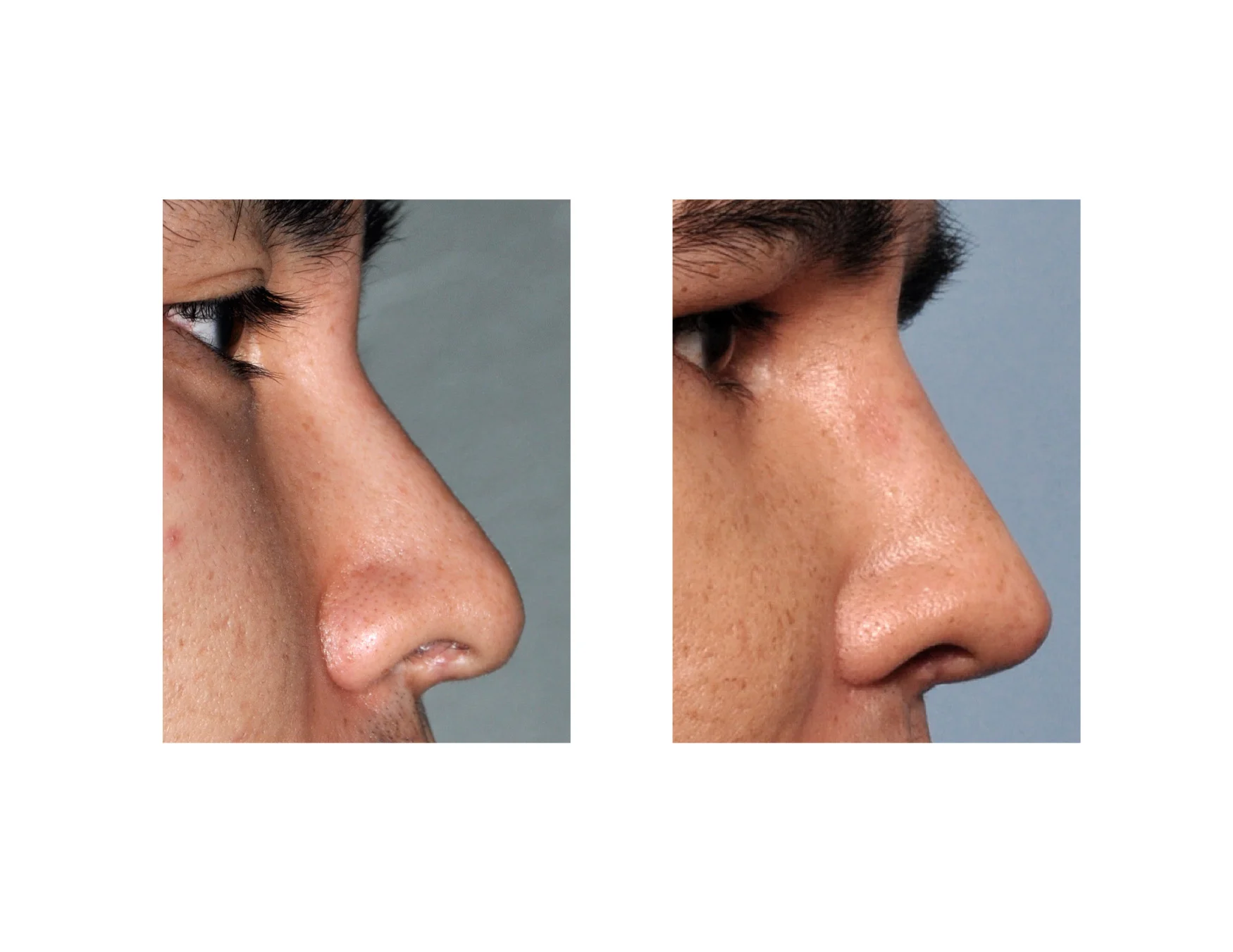 Nasal Implants (Improve Airflow and Enhance Aesthetics) 18 nasal implants3 Nasal Implants (Improve Airflow and Enhance Aesthetics)