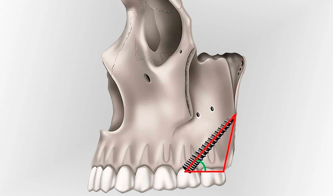 Pterygoid dental implants (Benefits, Risks & How They Compare to Zygomatic) 17 pterygoid dental implants1 Pterygoid dental implants (Benefits, Risks & How They Compare to Zygomatic)