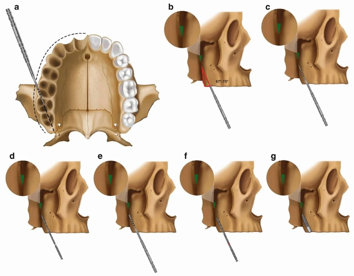Pterygoid dental implants (Benefits, Risks & How They Compare to Zygomatic) 16 pterygoid dental implants2 Pterygoid dental implants (Benefits, Risks & How They Compare to Zygomatic)