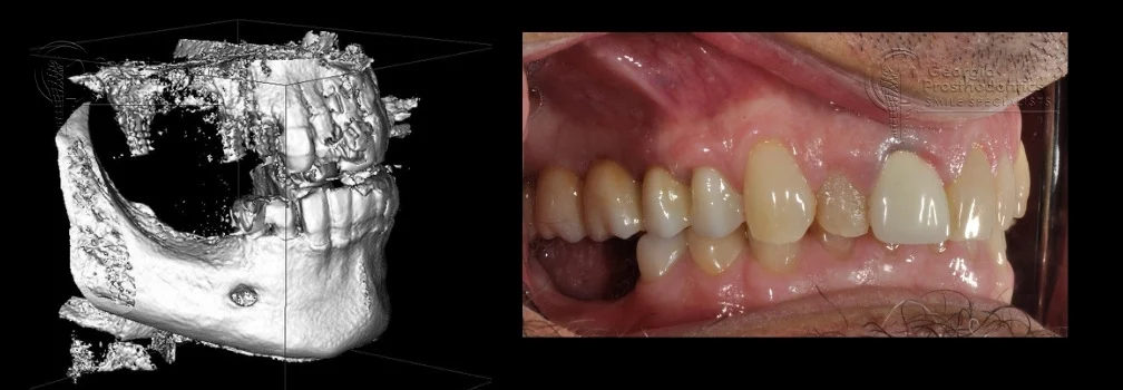 Pterygoid dental implants (Benefits, Risks & How They Compare to Zygomatic) 18 pterygoid dental implants3 Pterygoid dental implants (Benefits, Risks & How They Compare to Zygomatic)