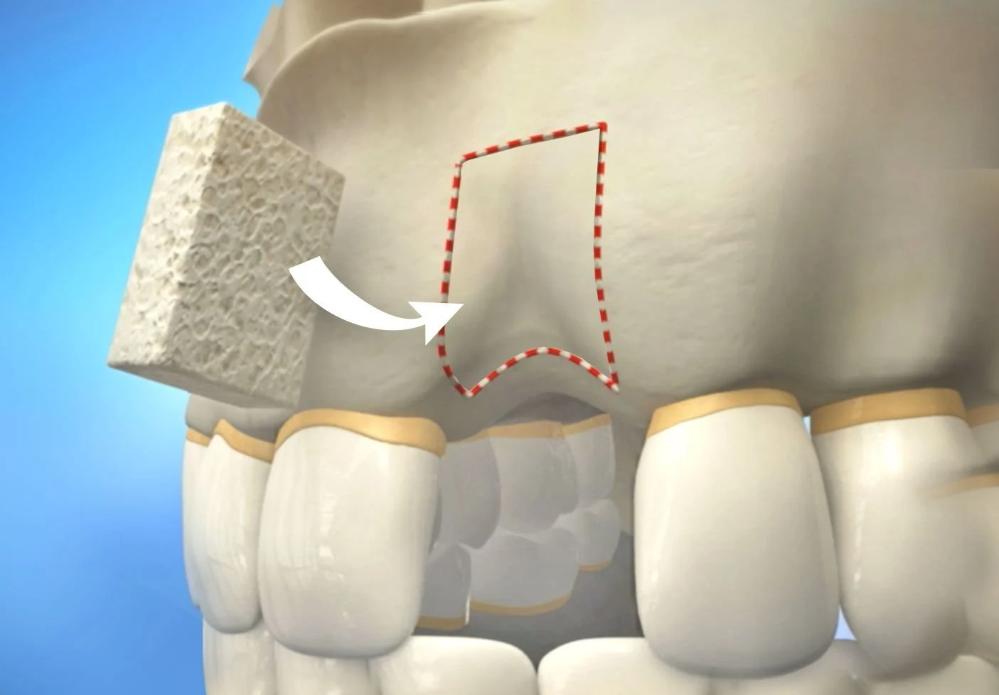 Ridge Augmentation (Cost, Healing Time & Bone Graft Options) 16 ridge augmentation1 Ridge Augmentation (Cost, Healing Time & Bone Graft Options)