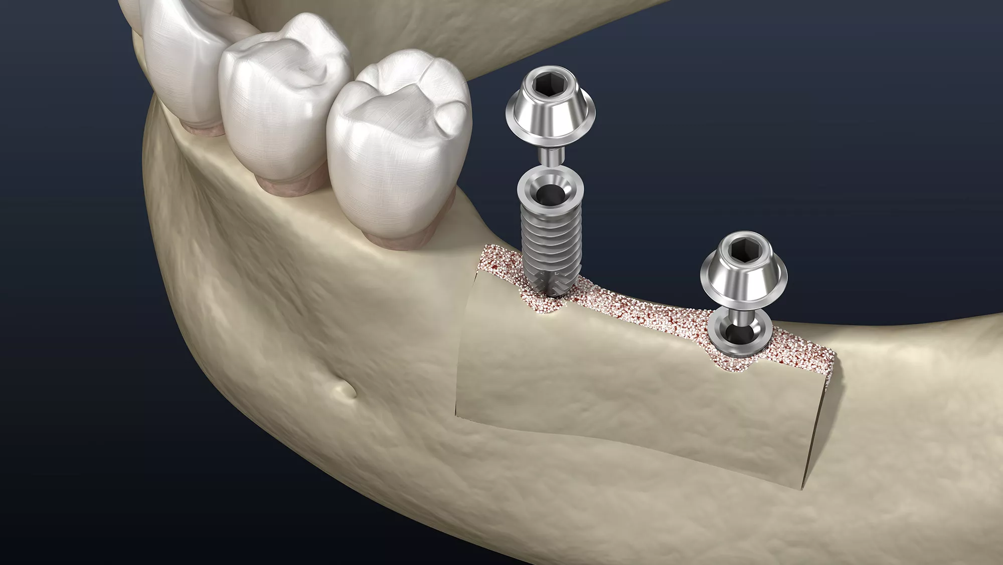 Ridge Augmentation (Cost, Healing Time & Bone Graft Options) 17 ridge augmentation2 Ridge Augmentation (Cost, Healing Time & Bone Graft Options)