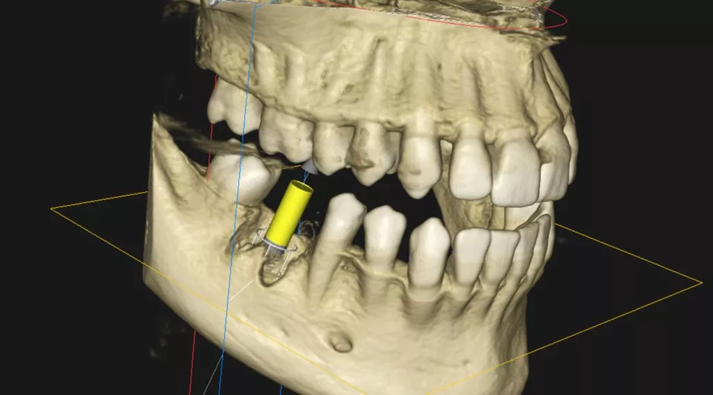 CBCT Scan Dental (Cost, Safety & Why It's Needed for Implants) 11 CBCT Scan Dental 1 CBCT Scan Dental (Cost, Safety & Why It's Needed for Implants)