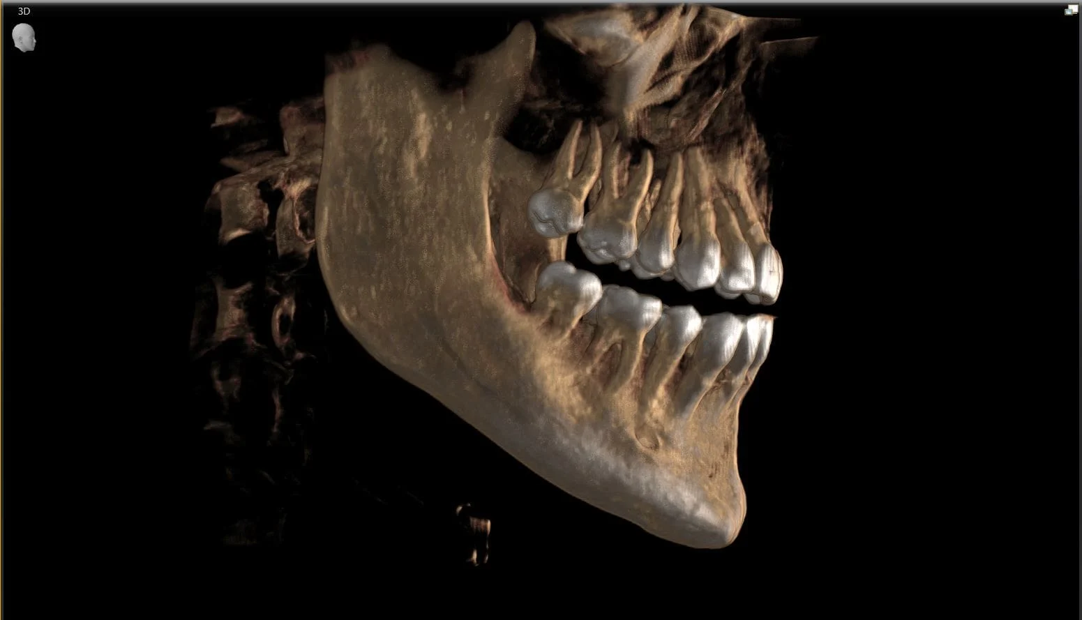 CBCT Scan Dental (Cost, Safety & Why It's Needed for Implants) 12 CBCT Scan Dental1 CBCT Scan Dental (Cost, Safety & Why It's Needed for Implants)