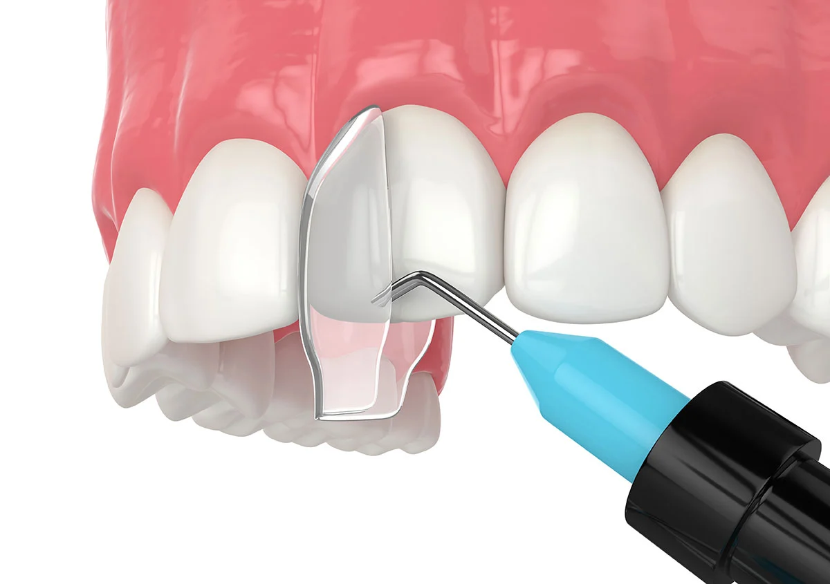 DENTAL BONDING Dental Bonding (Cost, Longevity & Best Candidates Explained)