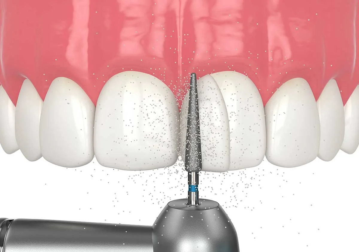 DENTAL BONDING3 Dental Bonding (Cost, Longevity & Best Candidates Explained)