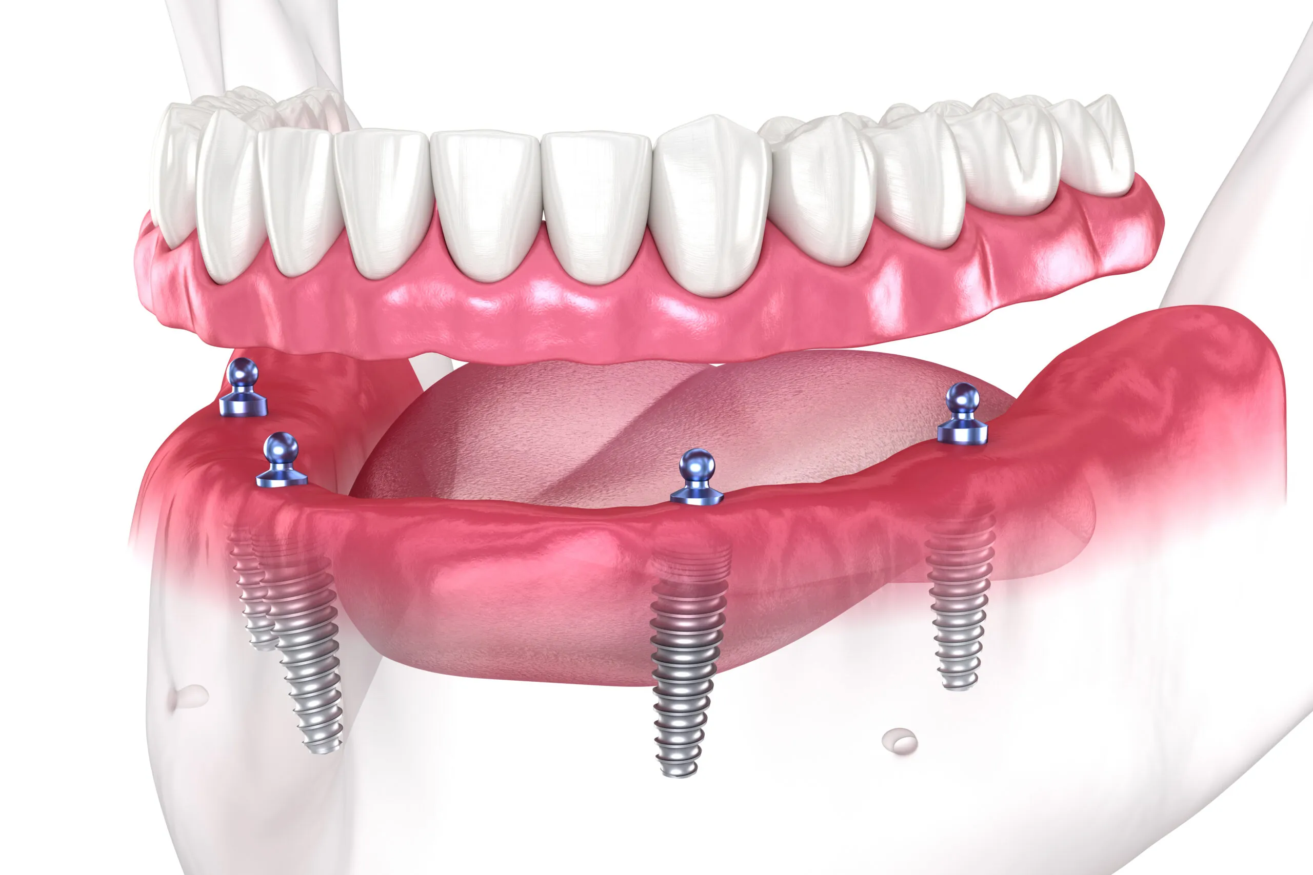 Dental Implants 2 Dental Implants (Costs, Pain, Procedure & Best Alternatives)