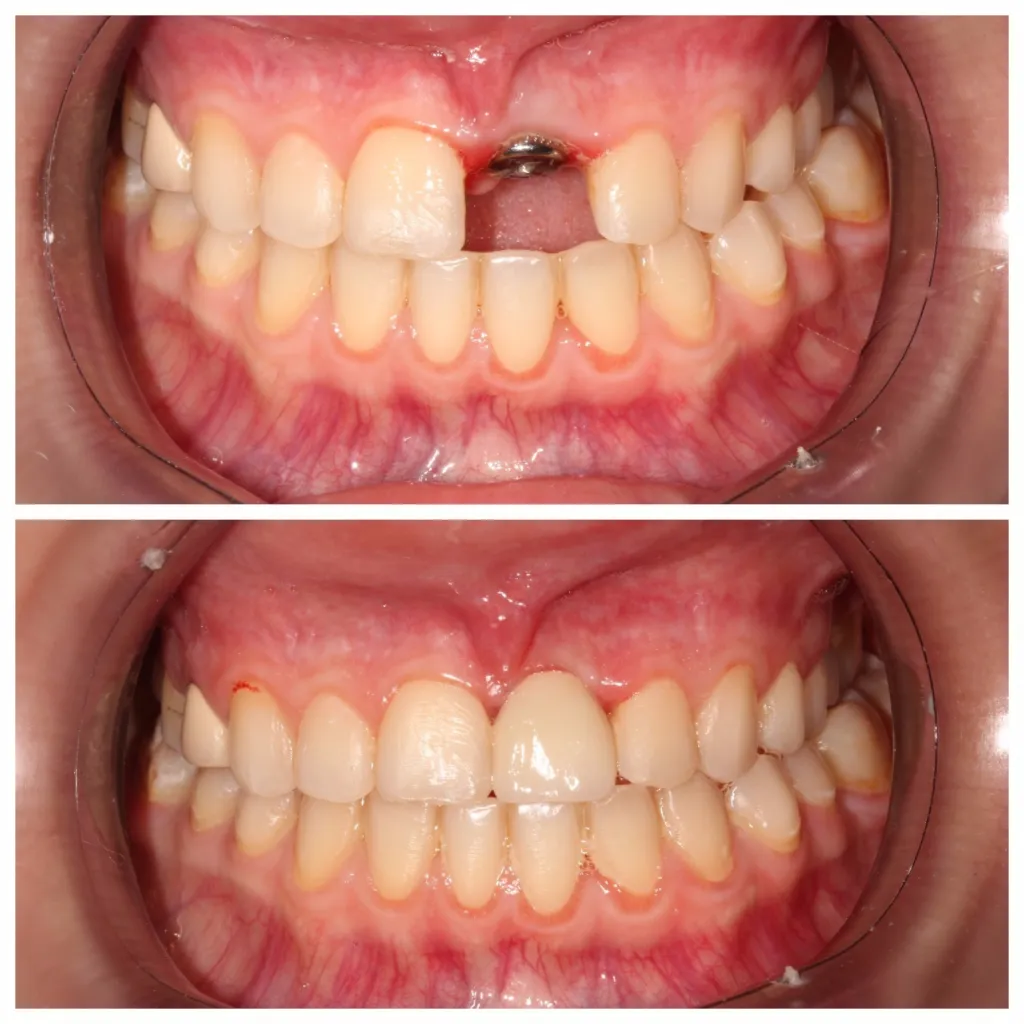 Dental Implants 3 Dental Implants (Costs, Pain, Procedure & Best Alternatives)