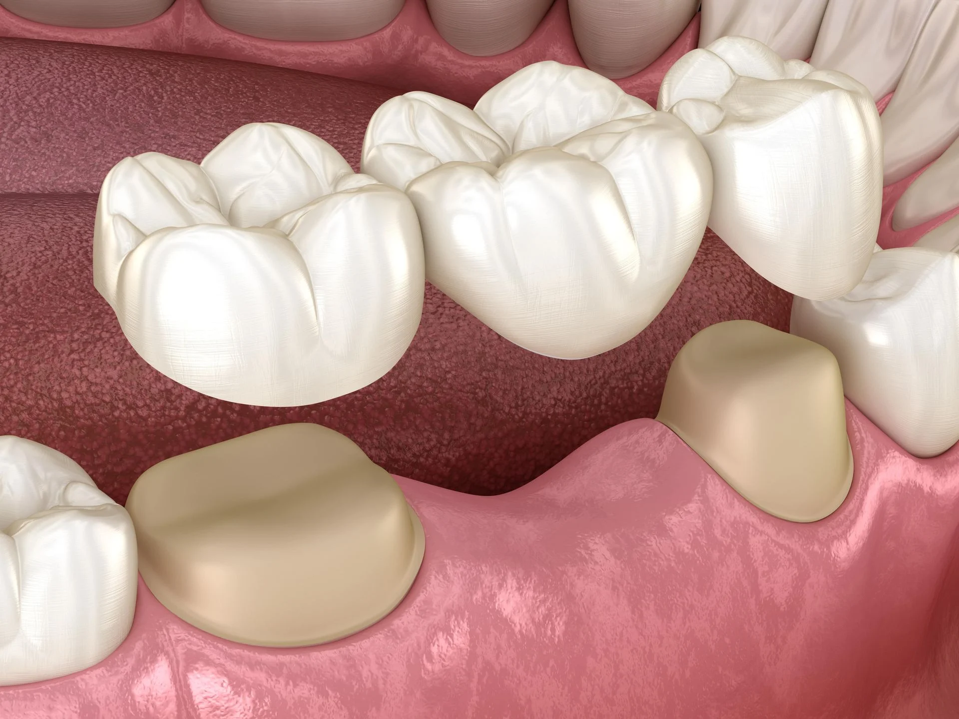 Dental bridge1 Dental Bridge (Types, Costs & What To Expect During The Procedure)