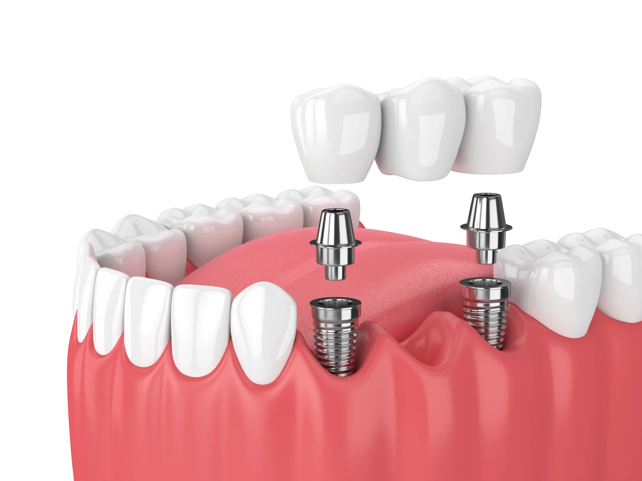 Dental bridge3 Dental Bridge (Types, Costs & What To Expect During The Procedure)