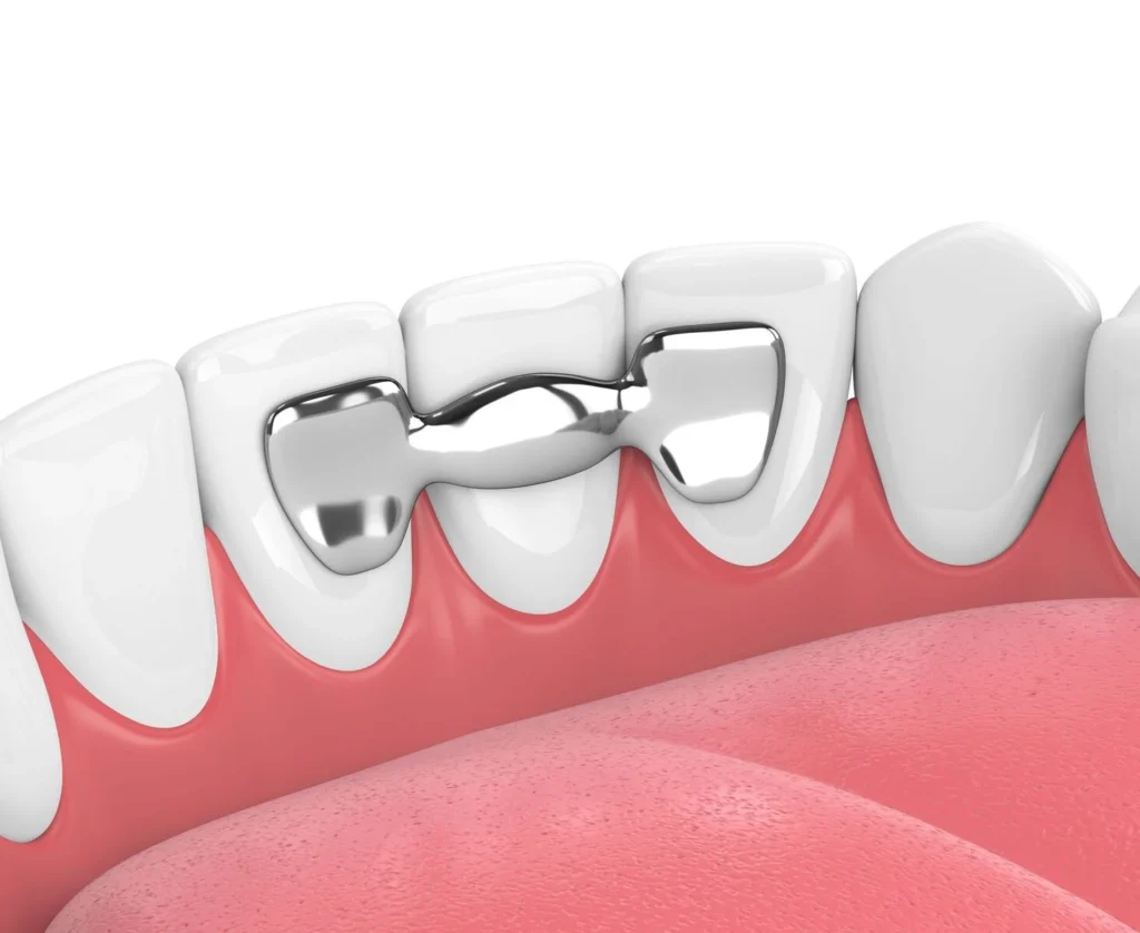 Dental bridge4 Dental Bridge (Types, Costs & What To Expect During The Procedure)
