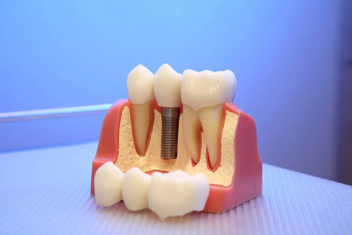 Dental Prosthodontics : What It Means, Who Needs It, and What to Expect 23 Dental prosthodontics2 Dental Prosthodontics : What It Means, Who Needs It, and What to Expect