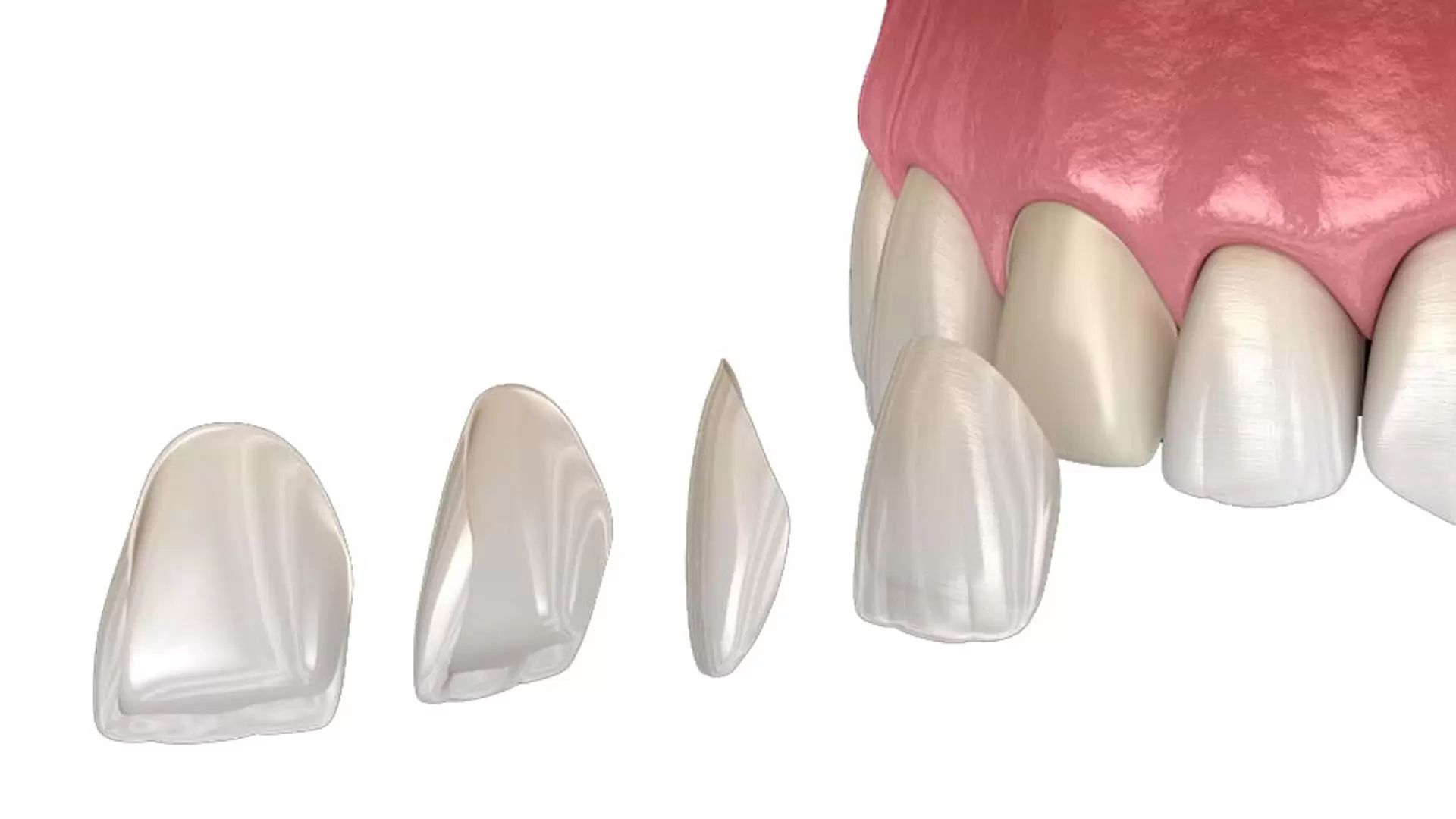 E-MAX Veneers: Everything You Need to Know 23 E MAX Veneers1 E-MAX Veneers: Everything You Need to Know