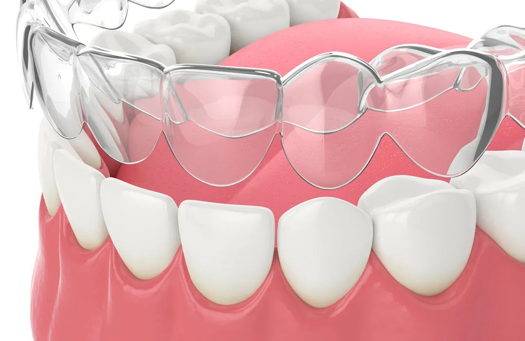 INVISALIGN.3 Invisalign (Cost, Pros & Cons, and If It's Worth the Money)