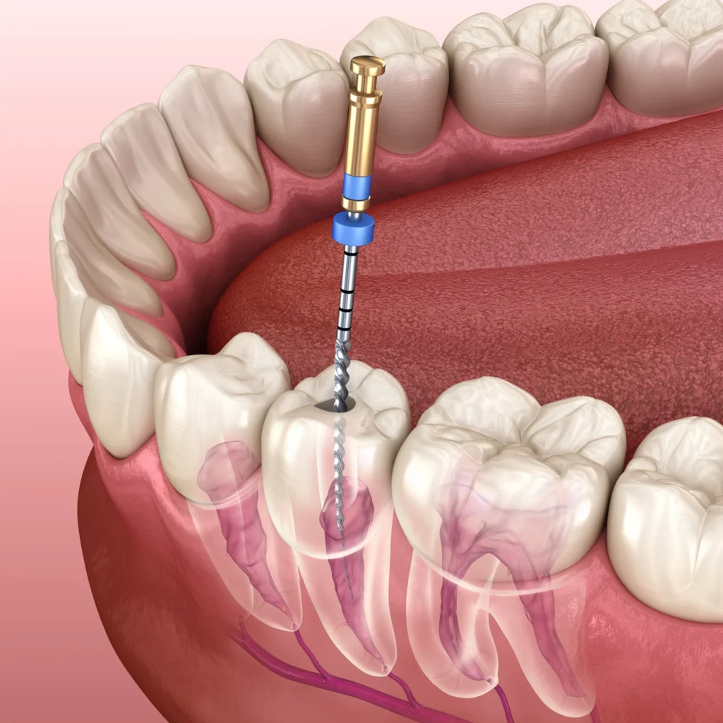 Root Canal Therapy: What It Is, How It Works, and What to Expect 26 Root canal therapy Root Canal Therapy: What It Is, How It Works, and What to Expect