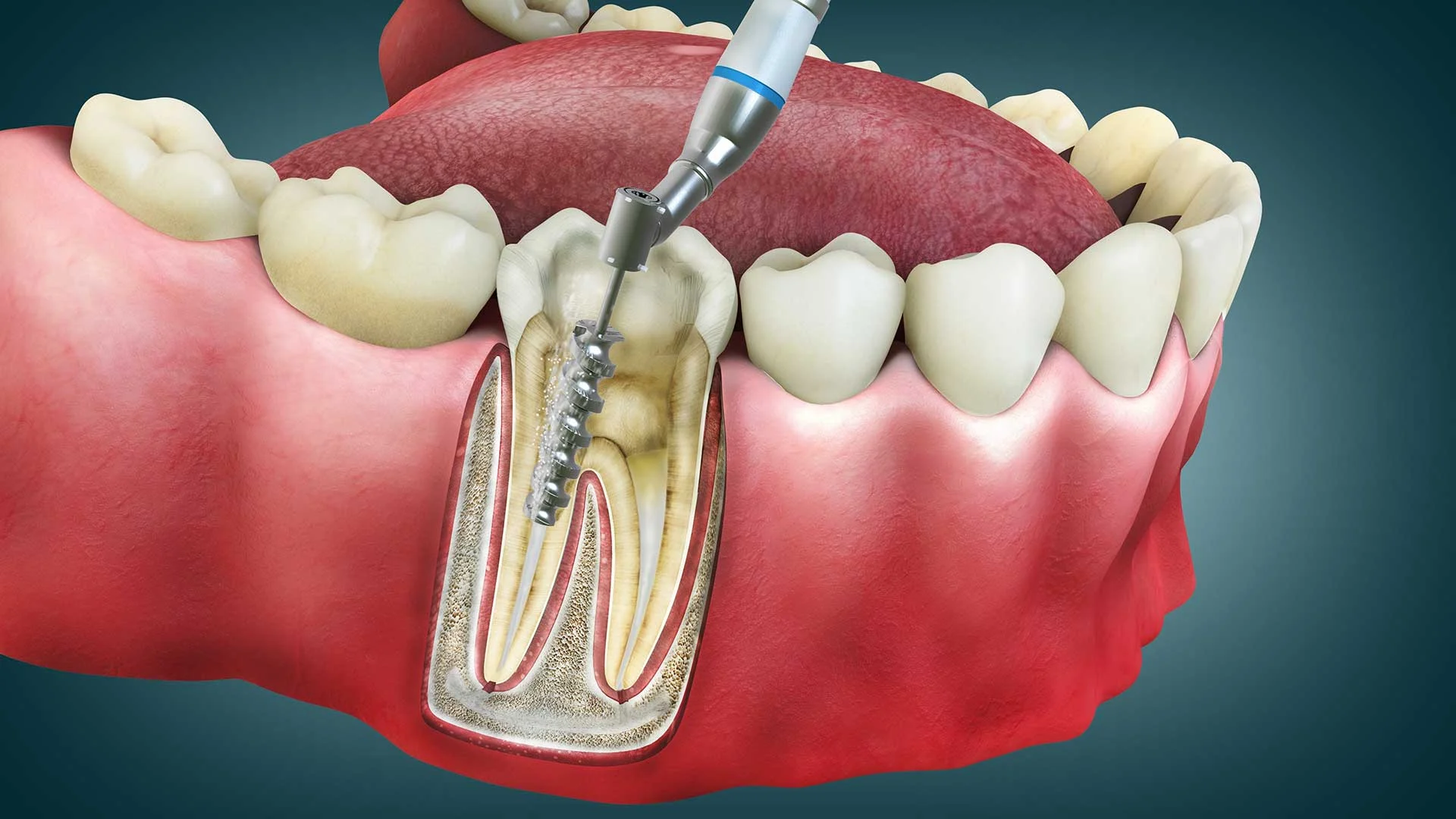 Root Canal Therapy: What It Is, How It Works, and What to Expect 27 Root canal therapy1 Root Canal Therapy: What It Is, How It Works, and What to Expect